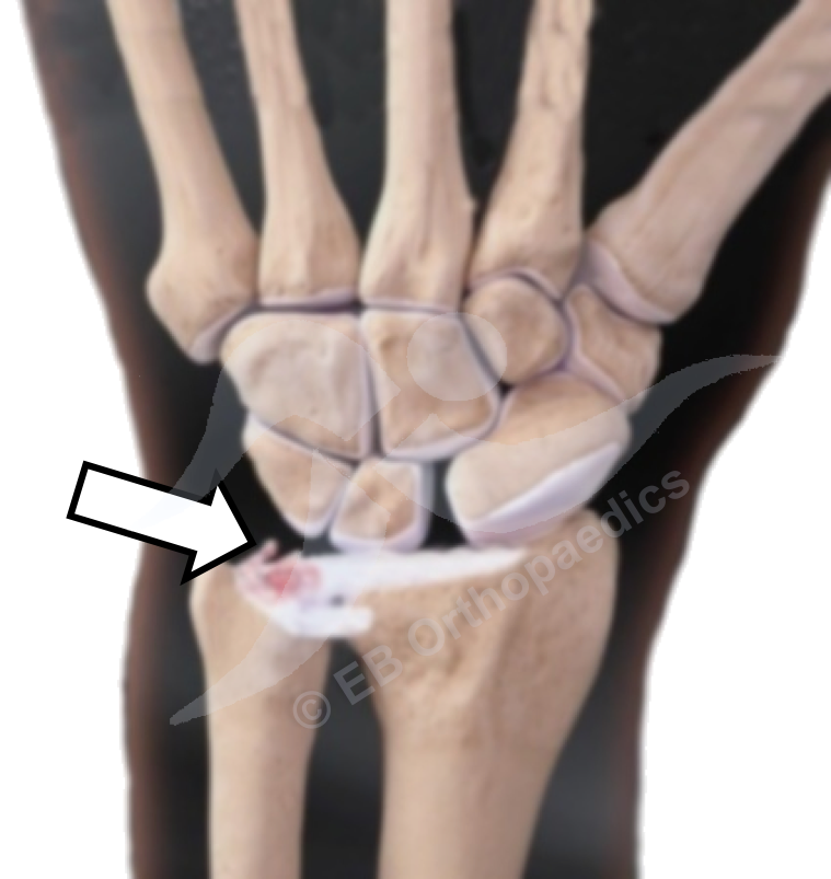 TFCC injury and tears